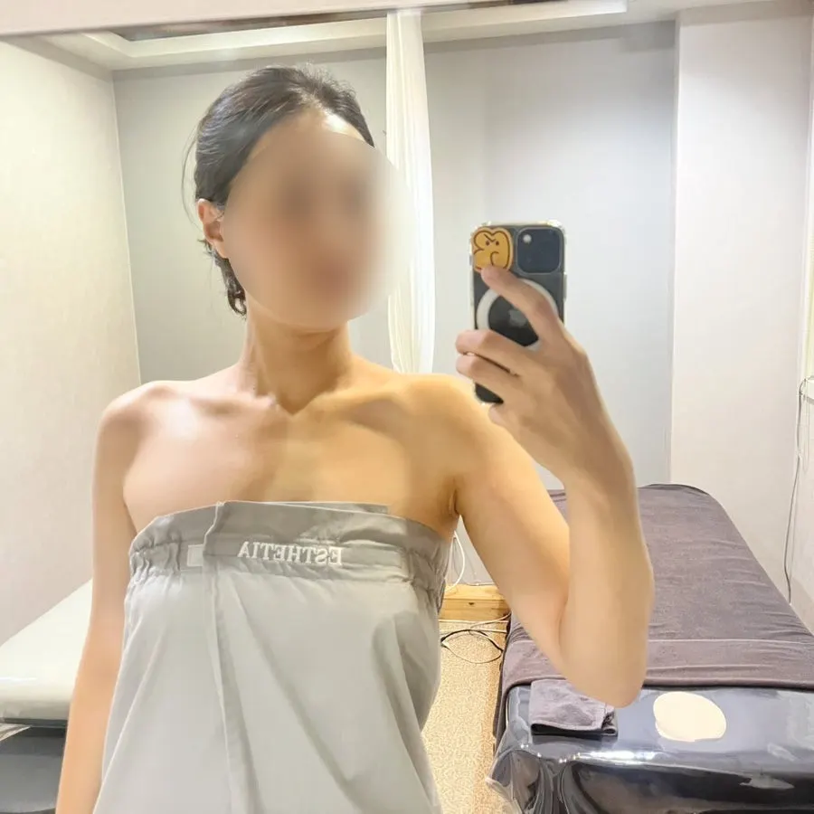 Before-and-after comparison of the trapezius line