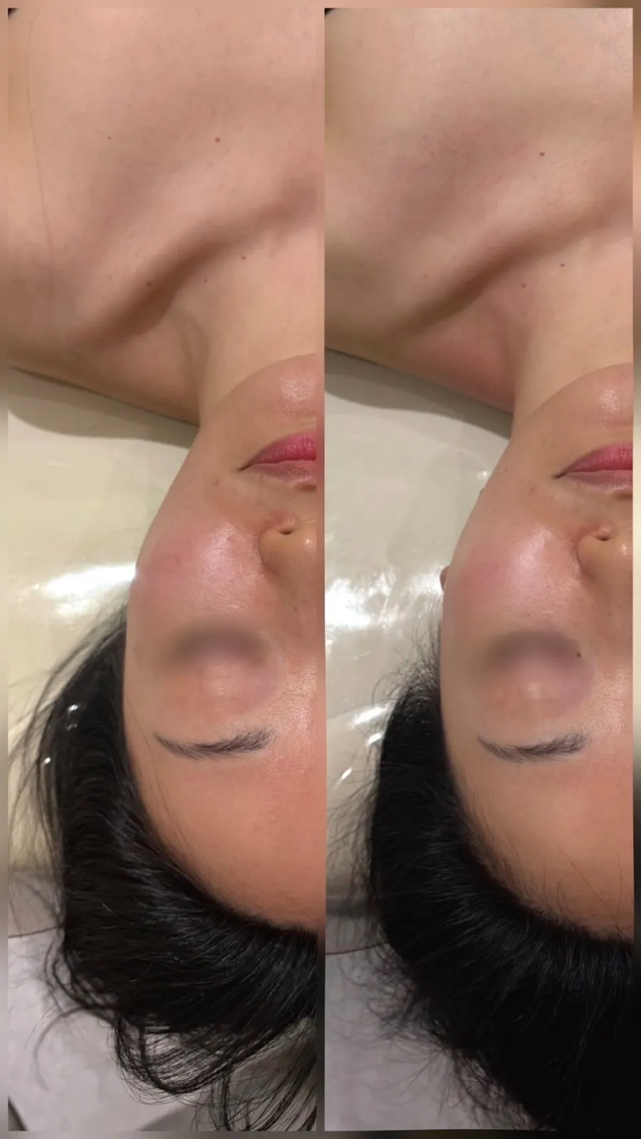 헤드앤넥 관리 전후 얼굴 비교