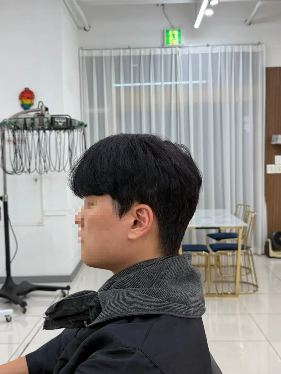 Front hairline before the treatment