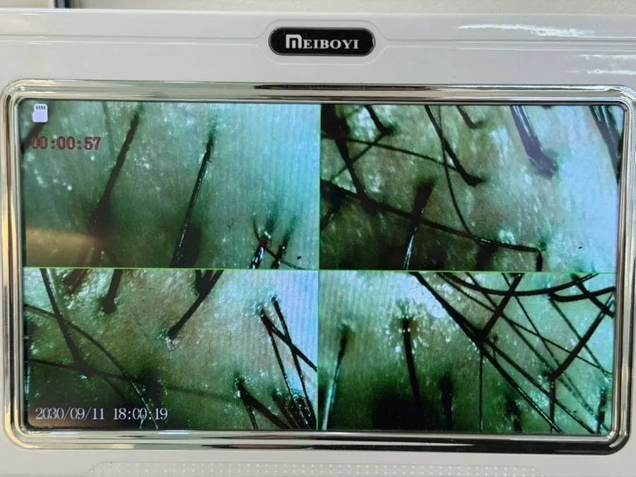 Screen showing the scalp measurement