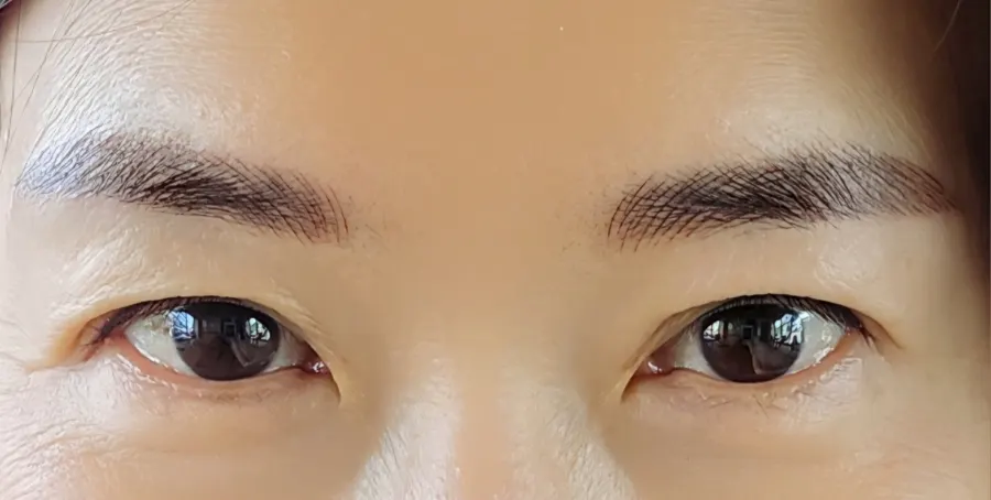 Close-up of eyebrows with red scarring covered