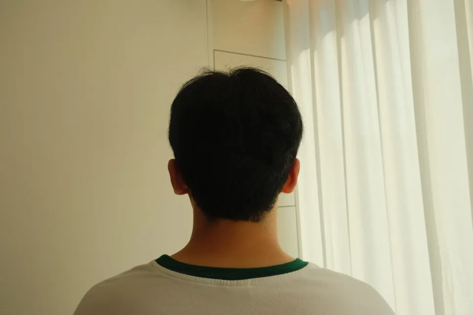 볼륨매직 시술 전 머리 상태