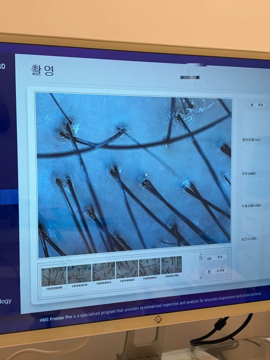 1시간 관리 후 두피 상태 확인 화면