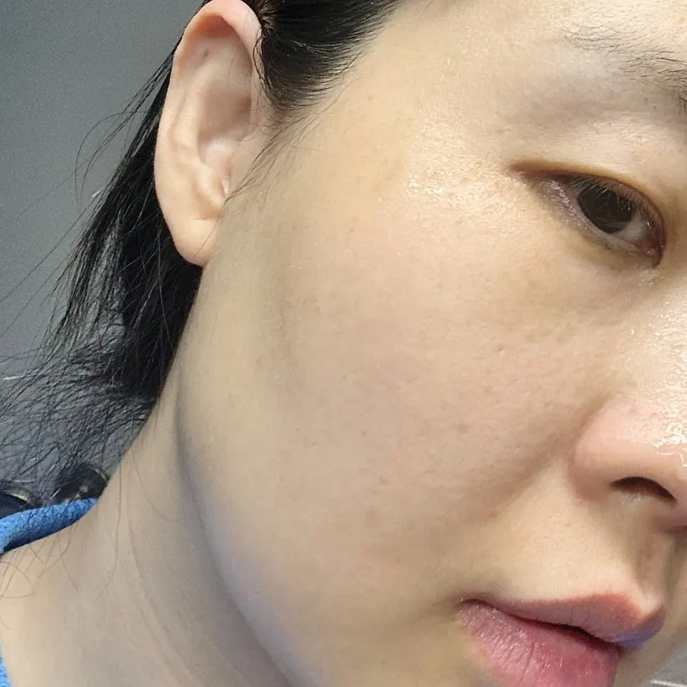 참숯 클렌징밤 2주 사용 후 피지 변화, 희다 지리산 촉촉 숯 클렌징밤