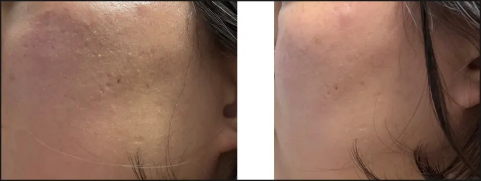 Charcoal cleansing foam for redness-prone skin: HEEDA Jirisan