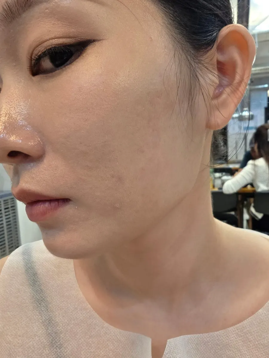 Skin condition around the nose sides and chin 12 hours later