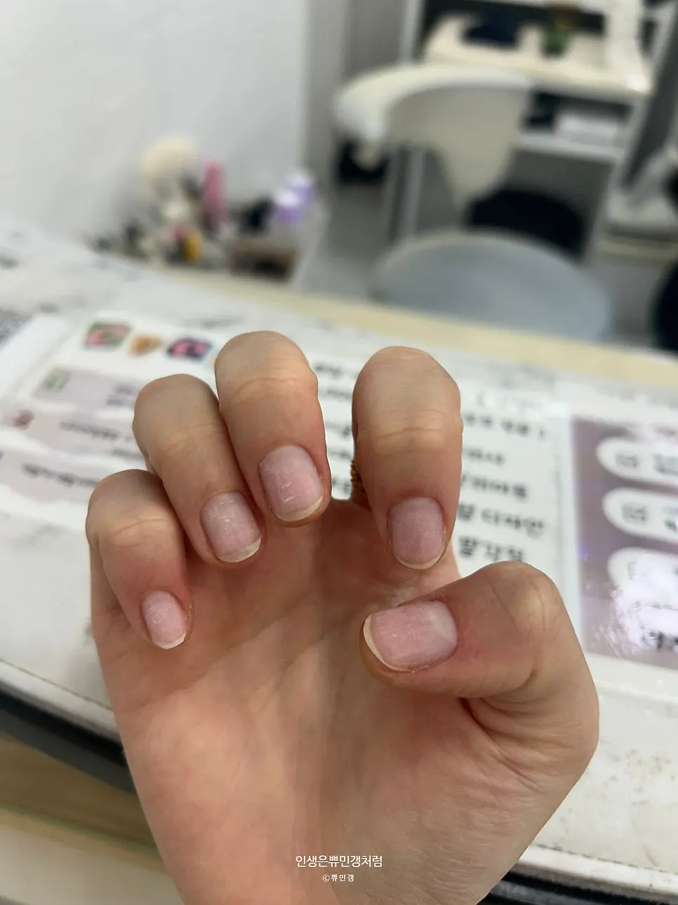 시술 전 손톱 측면 모습