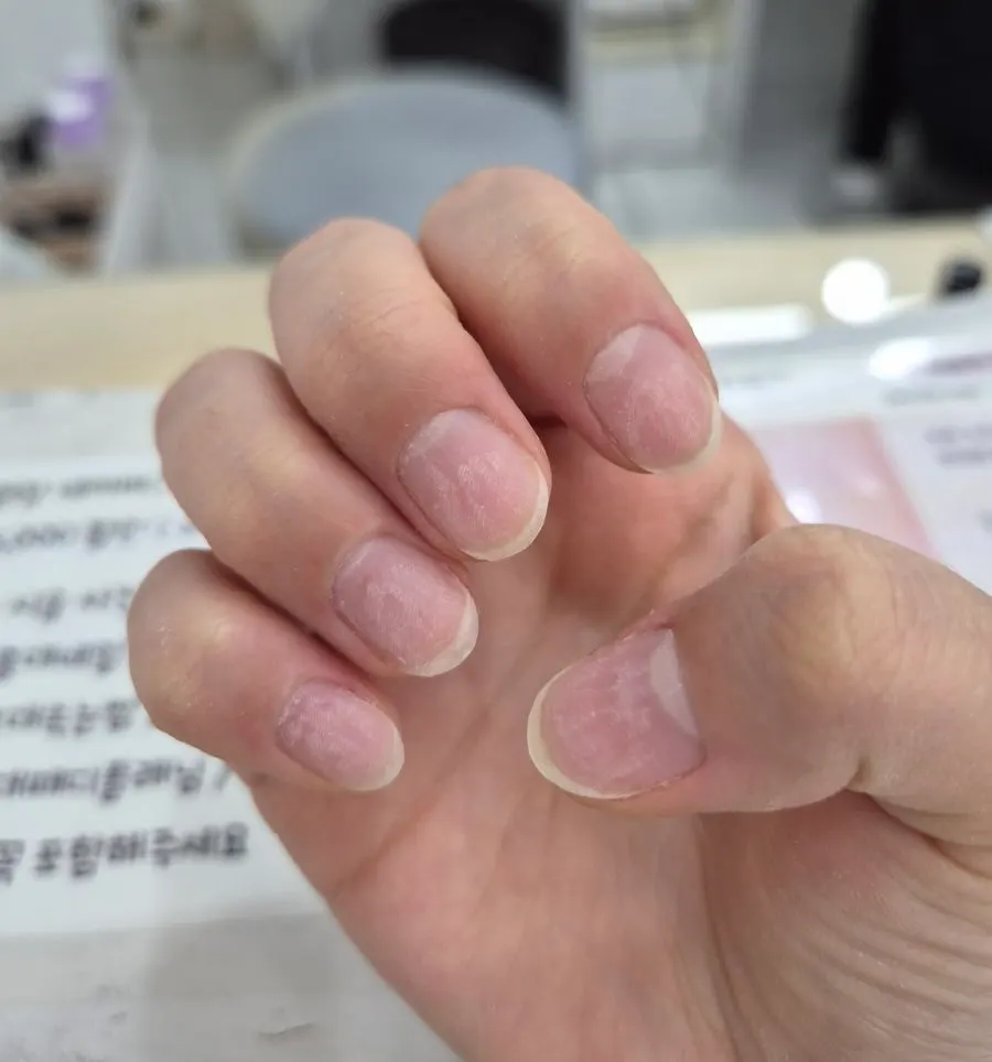 Nails after removal and shape correction