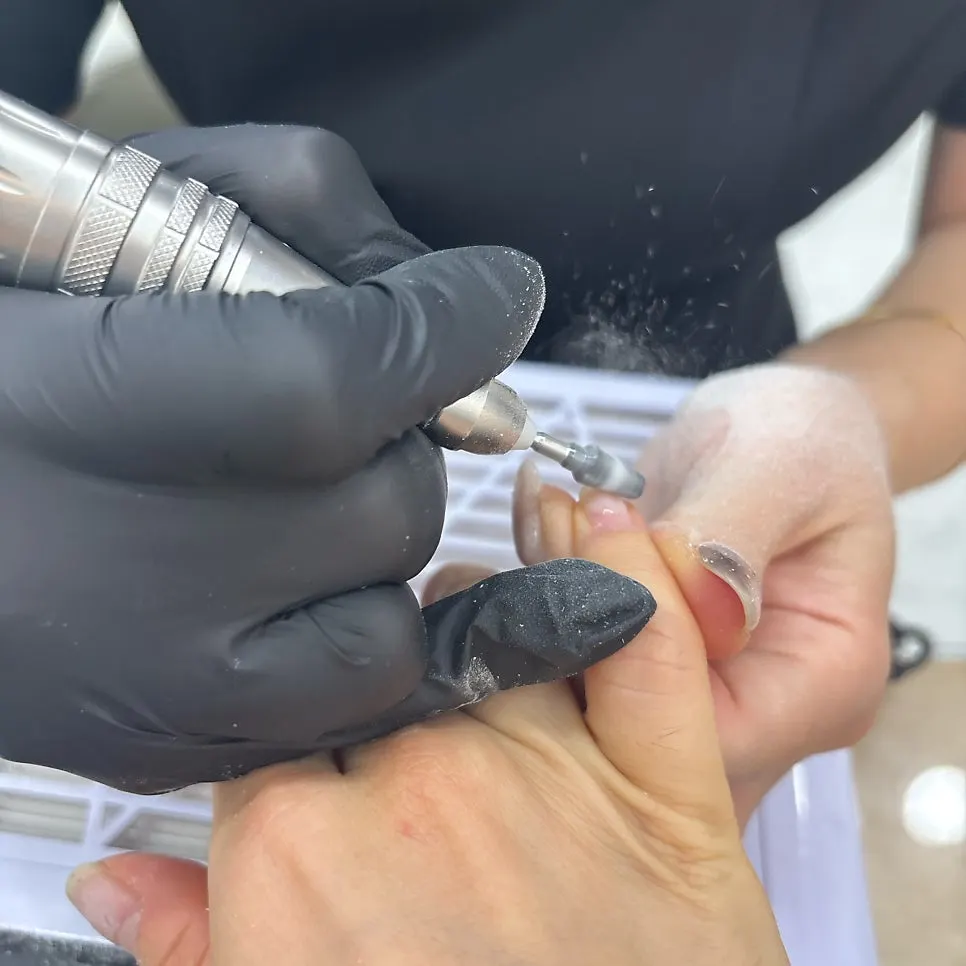 Nails before the treatment, cracked with overgrown cuticles