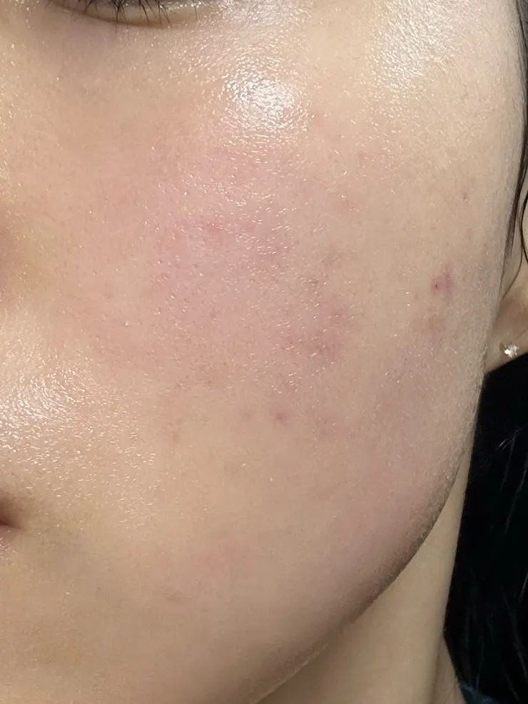 Moisturizing cream used alone on oily skin
