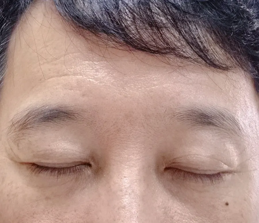 시술 전 정면에서 본 처진 눈썹
