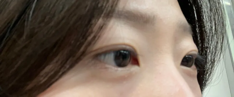 Selfie showing the heavy-looking eyes before the treatment