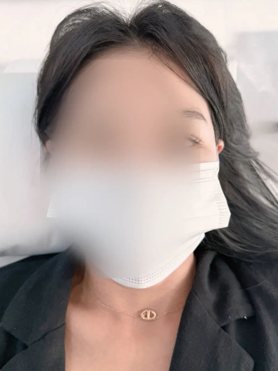 涙袋半永久直後の目元変化