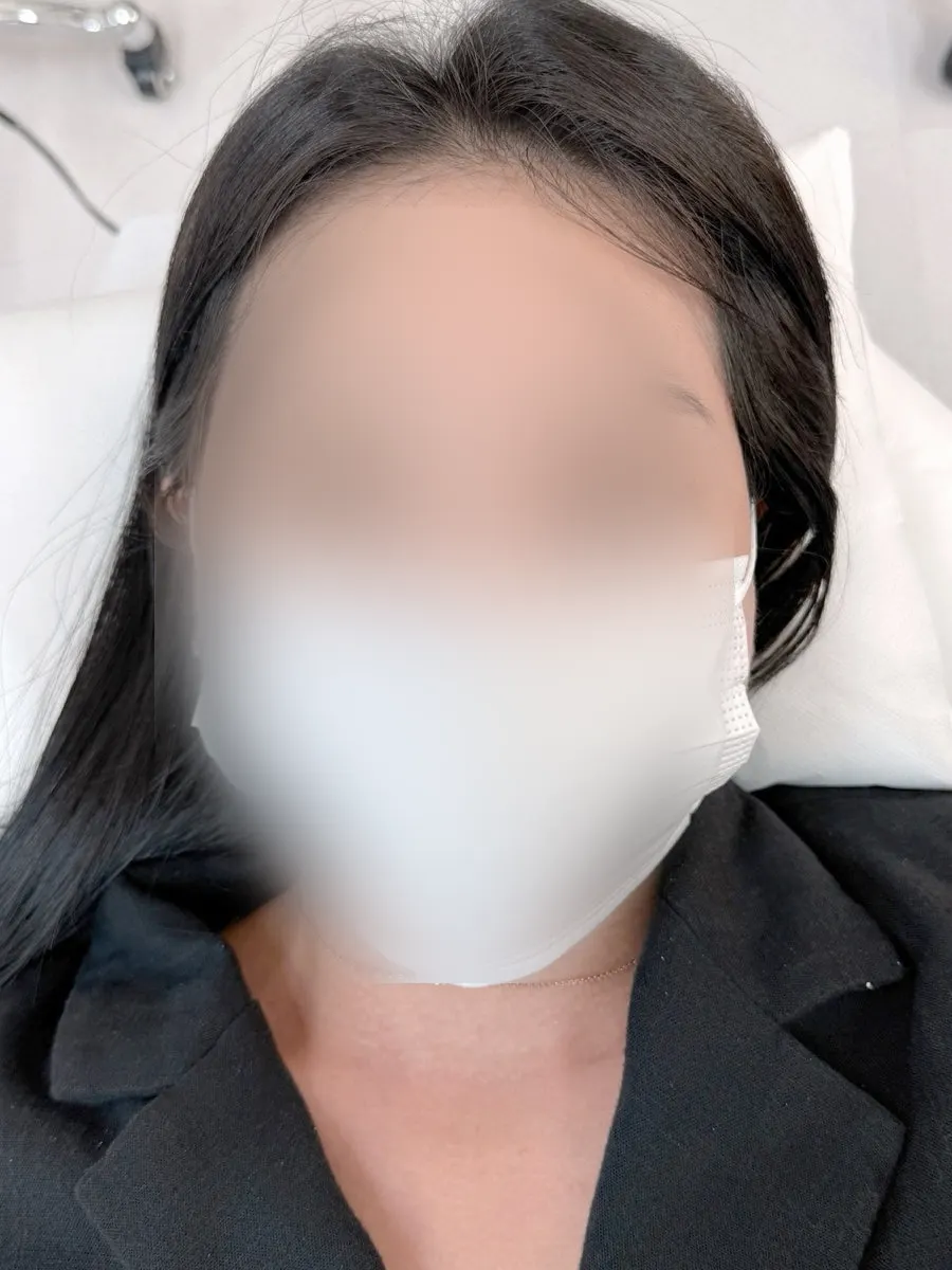 涙袋半永久後のはっきりした目元