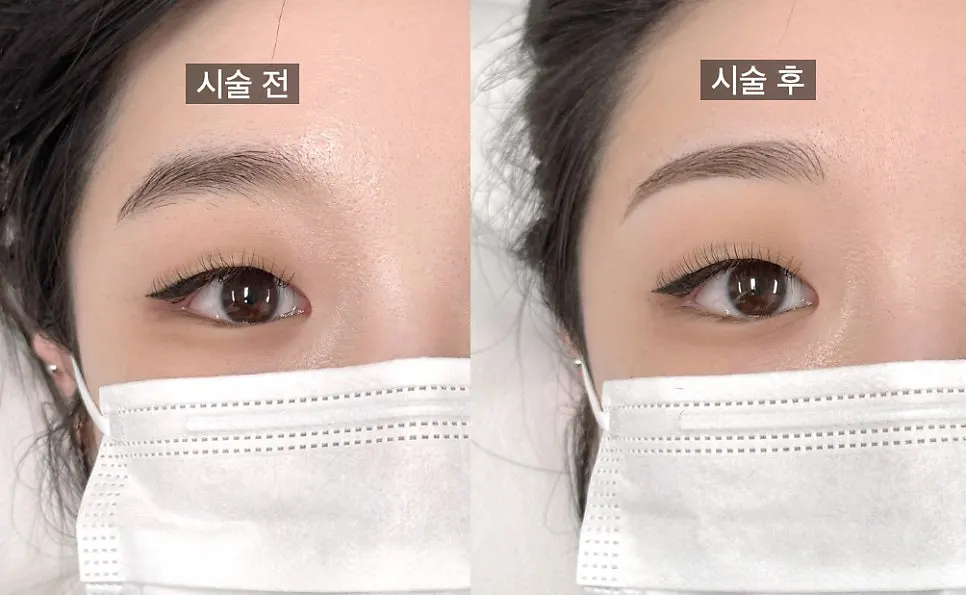 Photo of the naturally completed combo eyebrow result