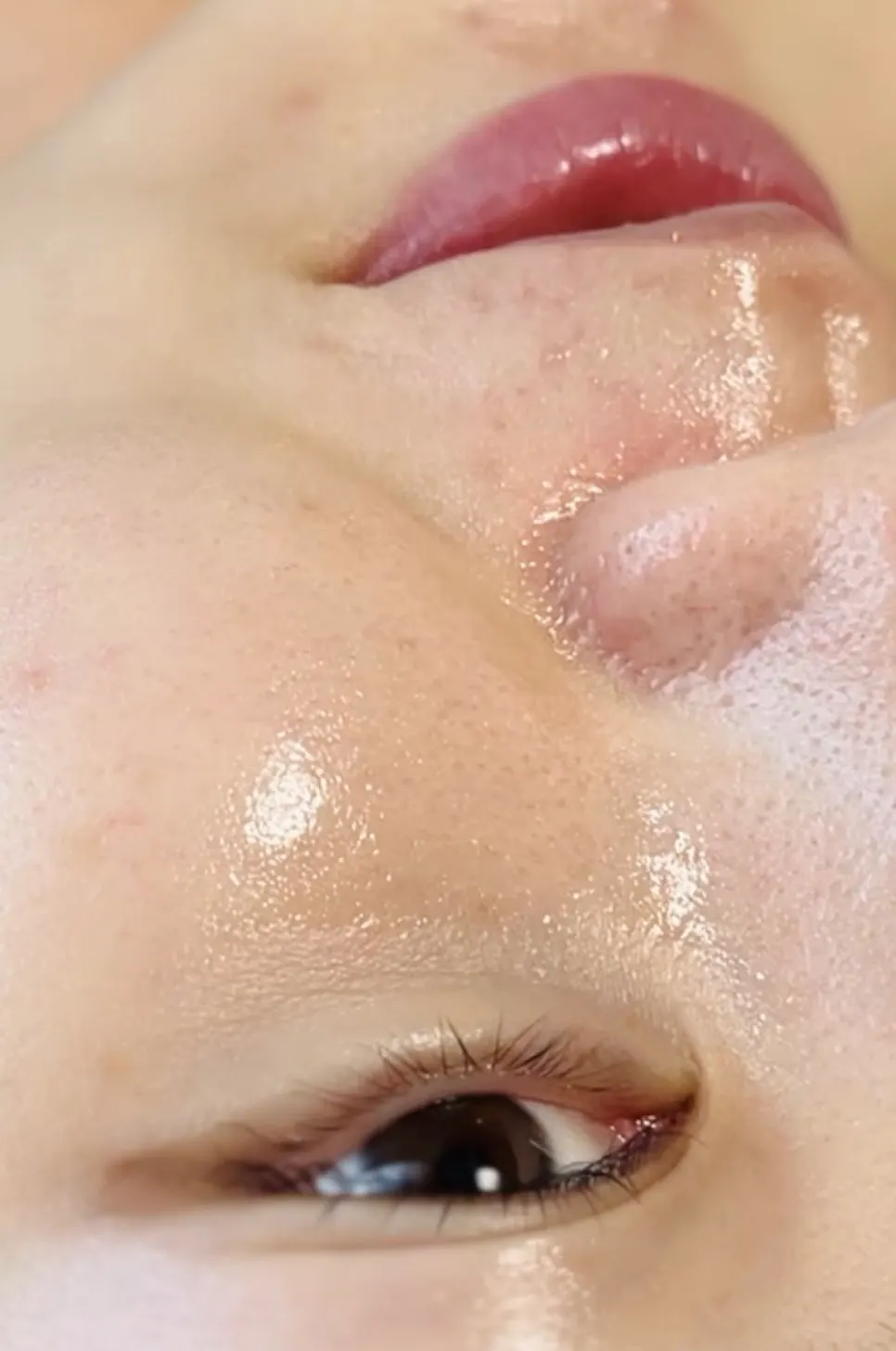Moisturized skin after the water-drop ultrasound treatment