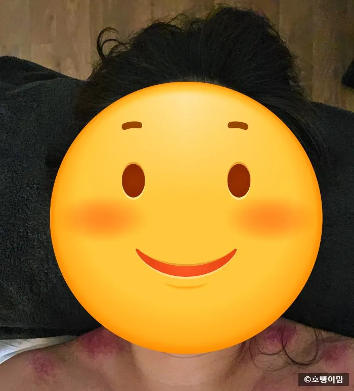 Treatment scene using gwasha alongside massage