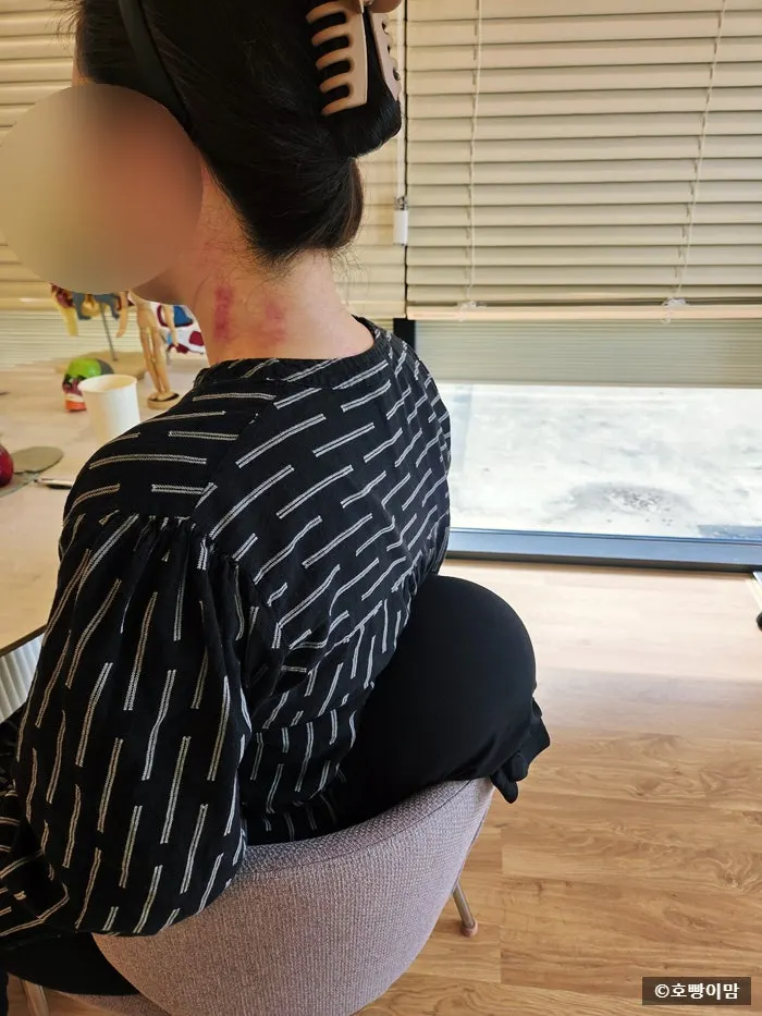 Red marks and bruising that appeared after the treatment