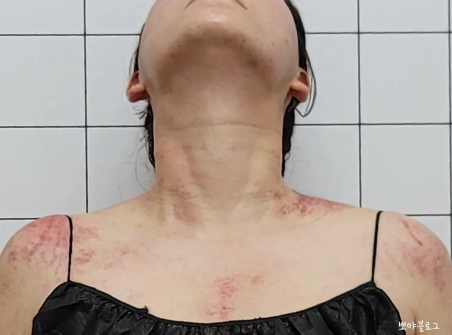 관리 후 편해진 어깨 상태 확인