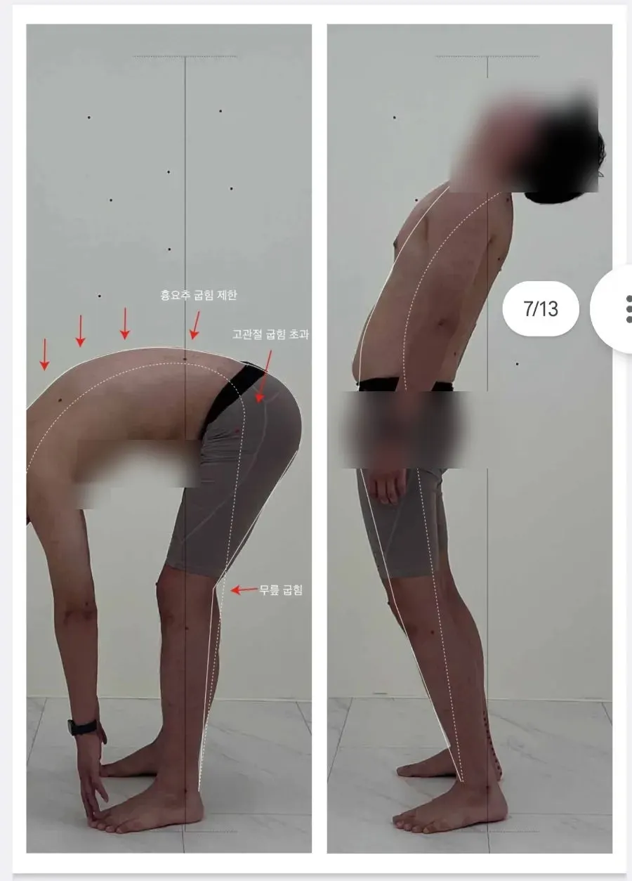 일자목과 거북목, 말린 어깨가 확인된 분석 결과
