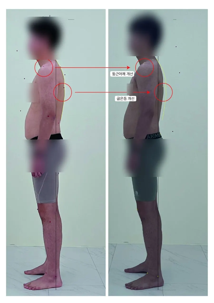 둥근 어깨와 굽은 등 개선된 비교 사진