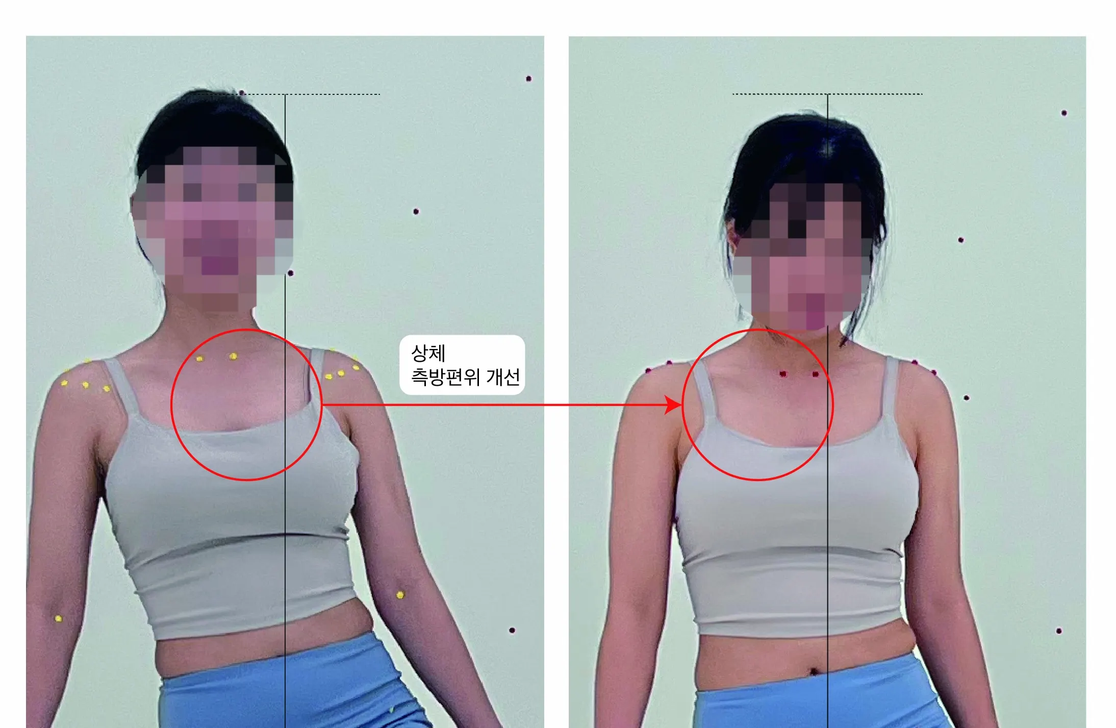 After photos taken with markings following the corrective exercise
