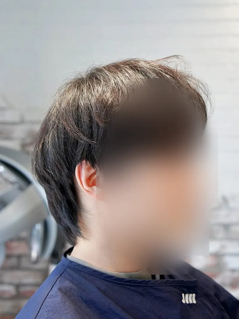 부분펌 비포 애프터 볼륨 비교