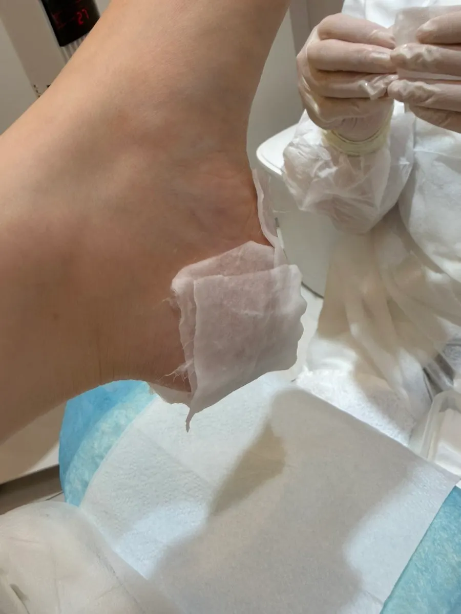 用角质软化剂软化角质的过程