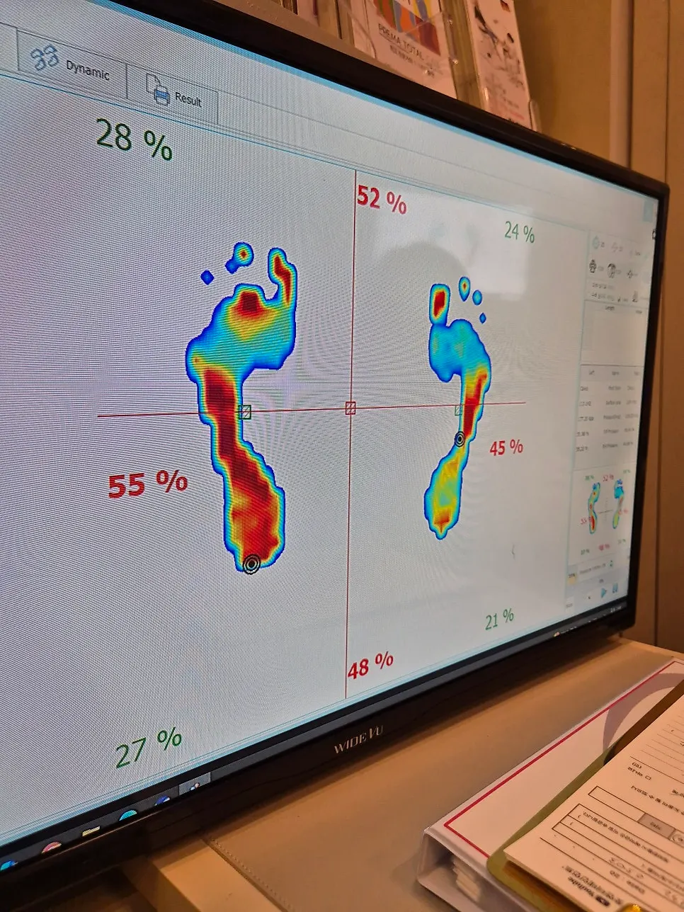 Measuring the foot with 3D foot analysis equipment