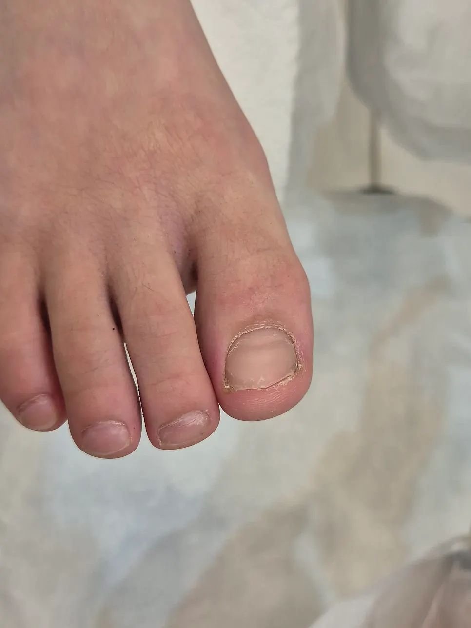 Before photo of the right big toenail digging into the flesh