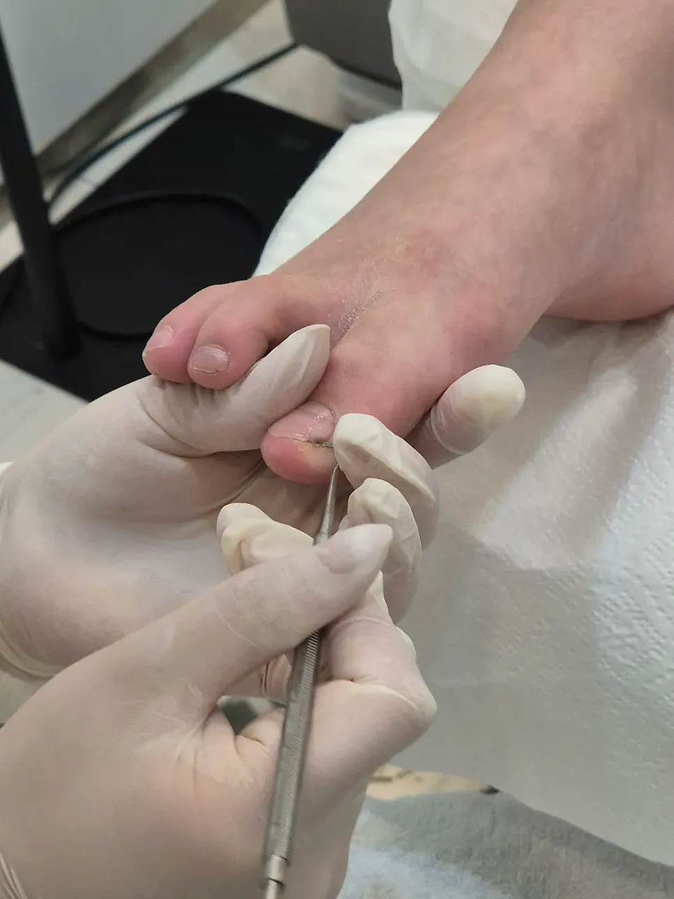 Removing calluses and debris under the nail