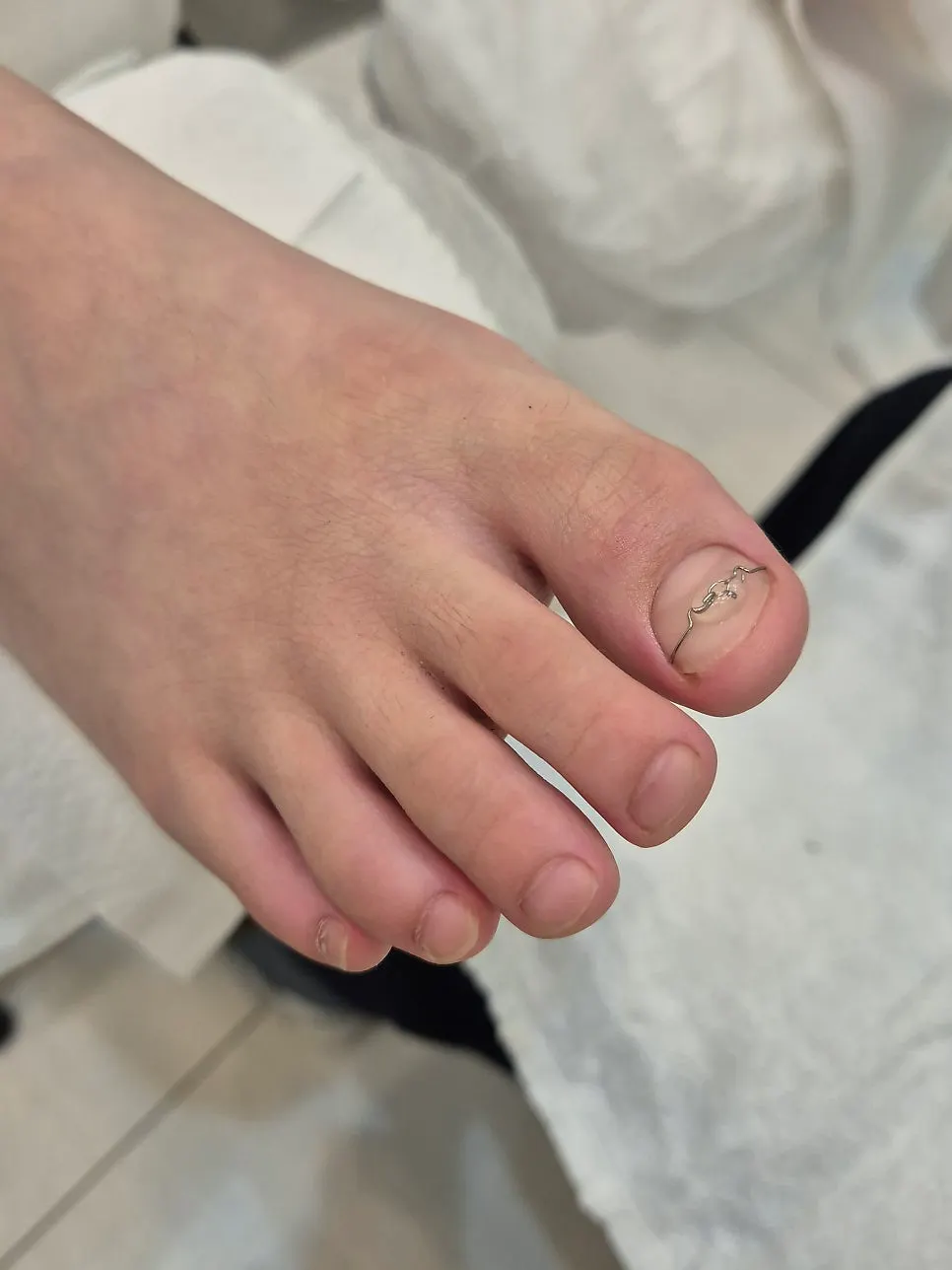 Adjusting the 3TO device's position to fit the nail shape