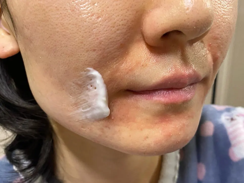 Using cream on sensitive, very dry skin