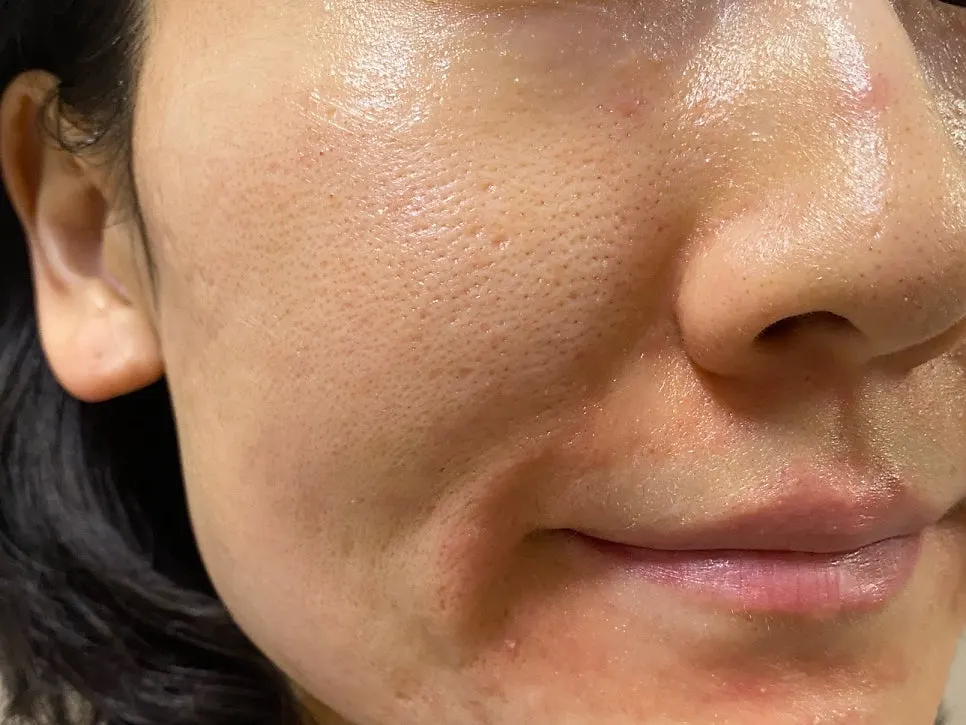 Cream applied as an overnight mask on the chin and around the mouth