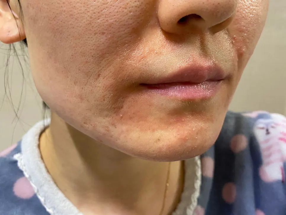 Skin immediately after applying collagen cream