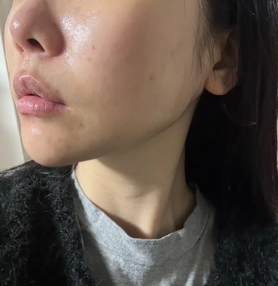 Skin condition after cleansing and before basic skincare