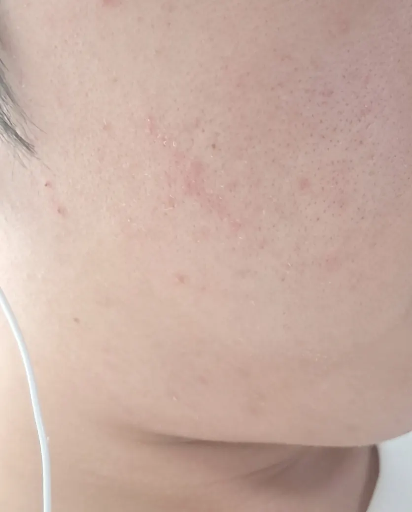 2주간 사용한 트러블 피부 관리 이미지