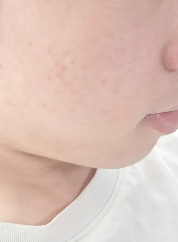 보습과 각질 관리를 위한 크림 사용