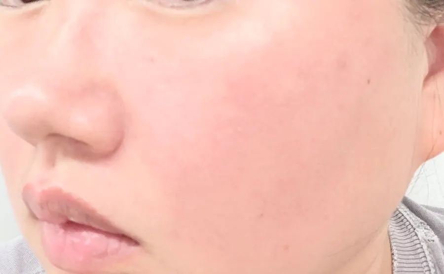 Skin before applying the sunscreen
