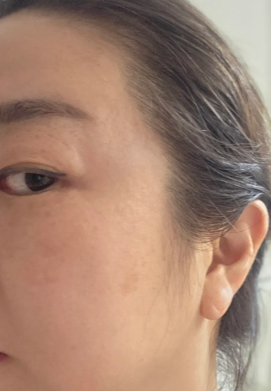 Comparison photo of skin condition before using the ampoule
