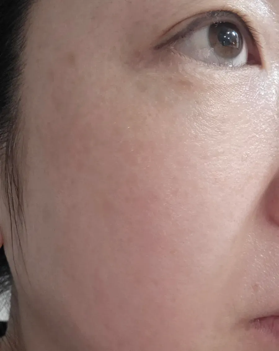 Record of skin condition before and after 2 weeks of use