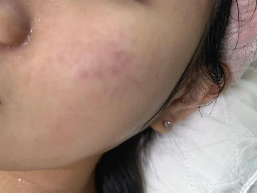 Skin care after rinsing off the mask