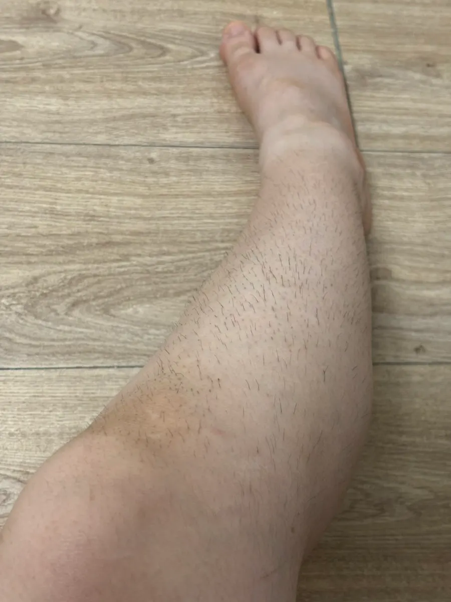 Short, coarse leg hair before hair removal