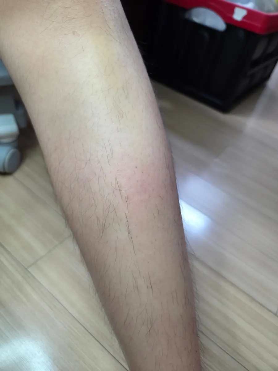 제모 크림 사용 후 정리된 피부