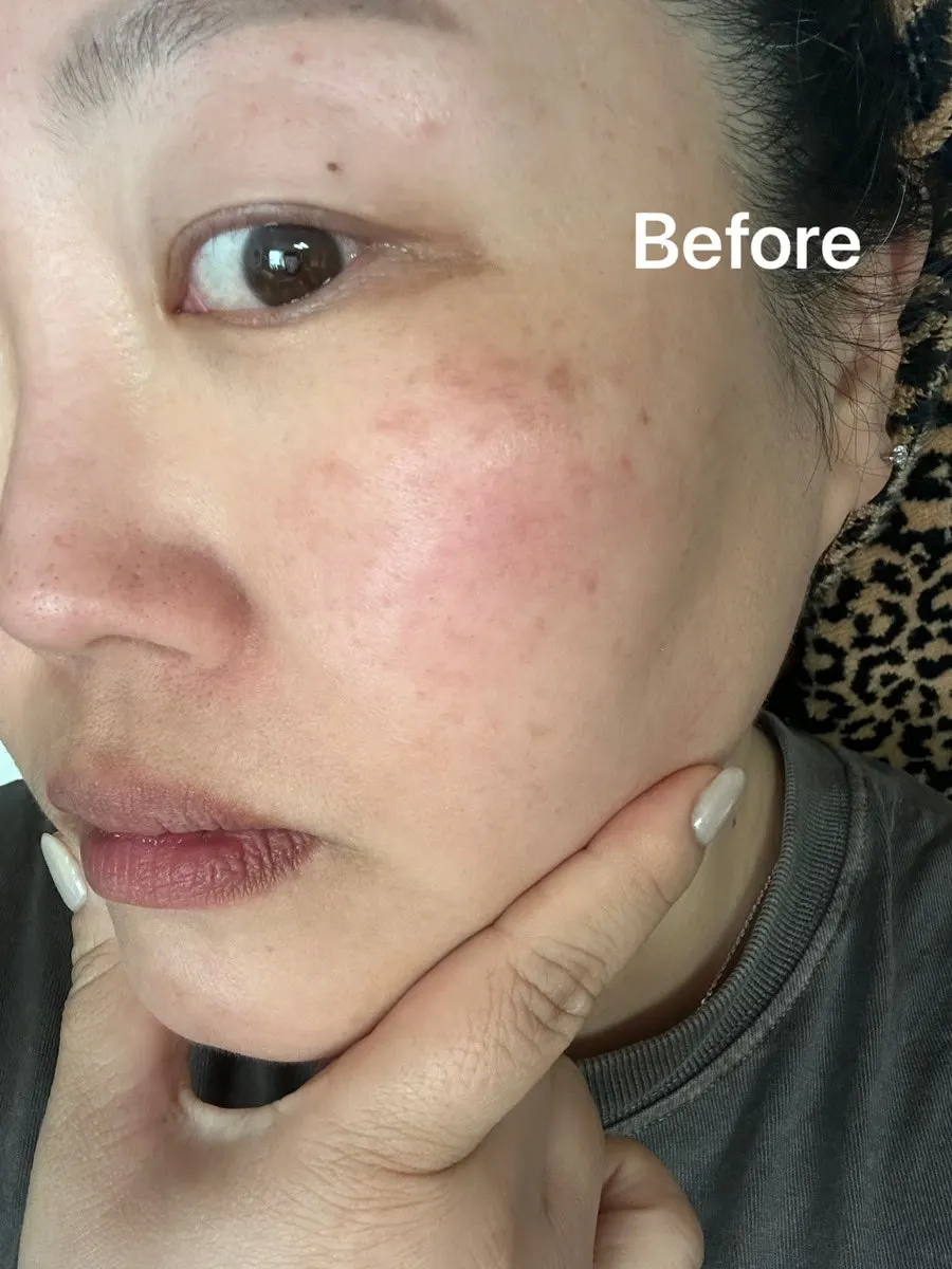 Skin record before and after using the vitamin ampoule