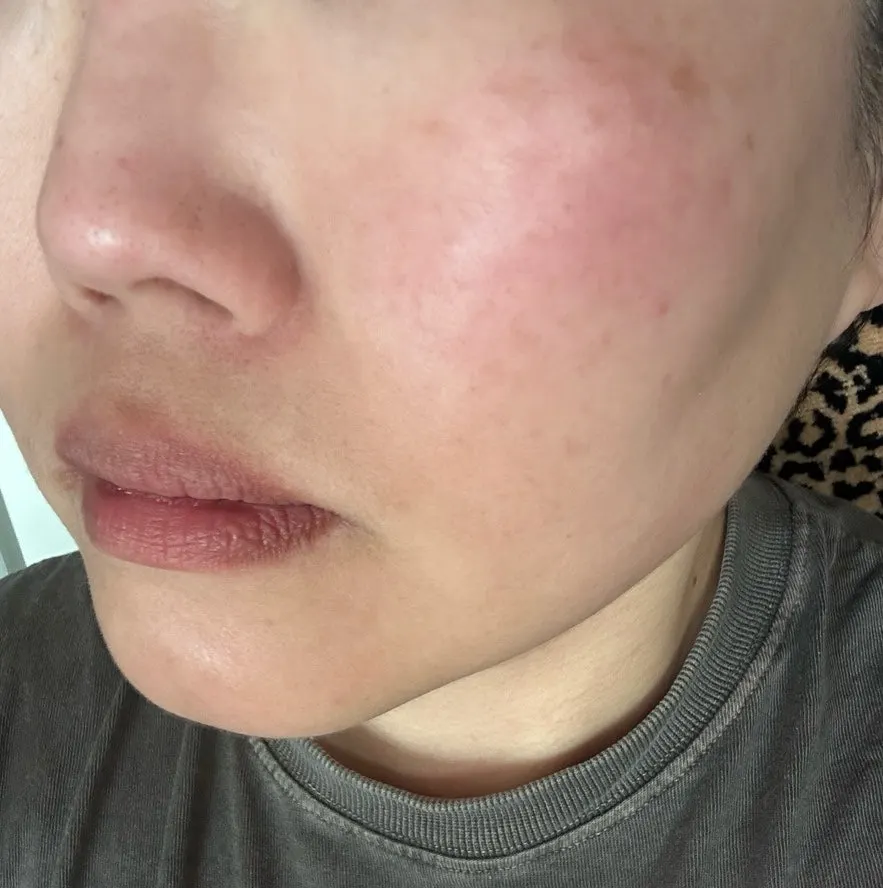 Skin-tone comparison record after using the ampoule