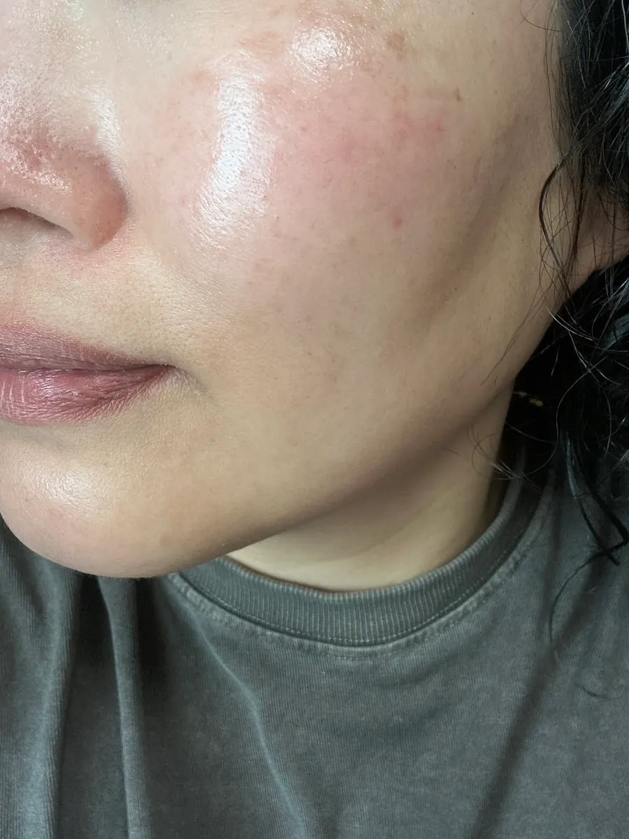 Skin record after using the vitamin ampoule