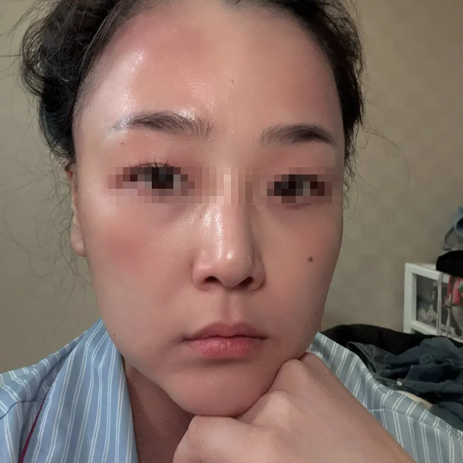 비타민 앰플 2주 사용 기록