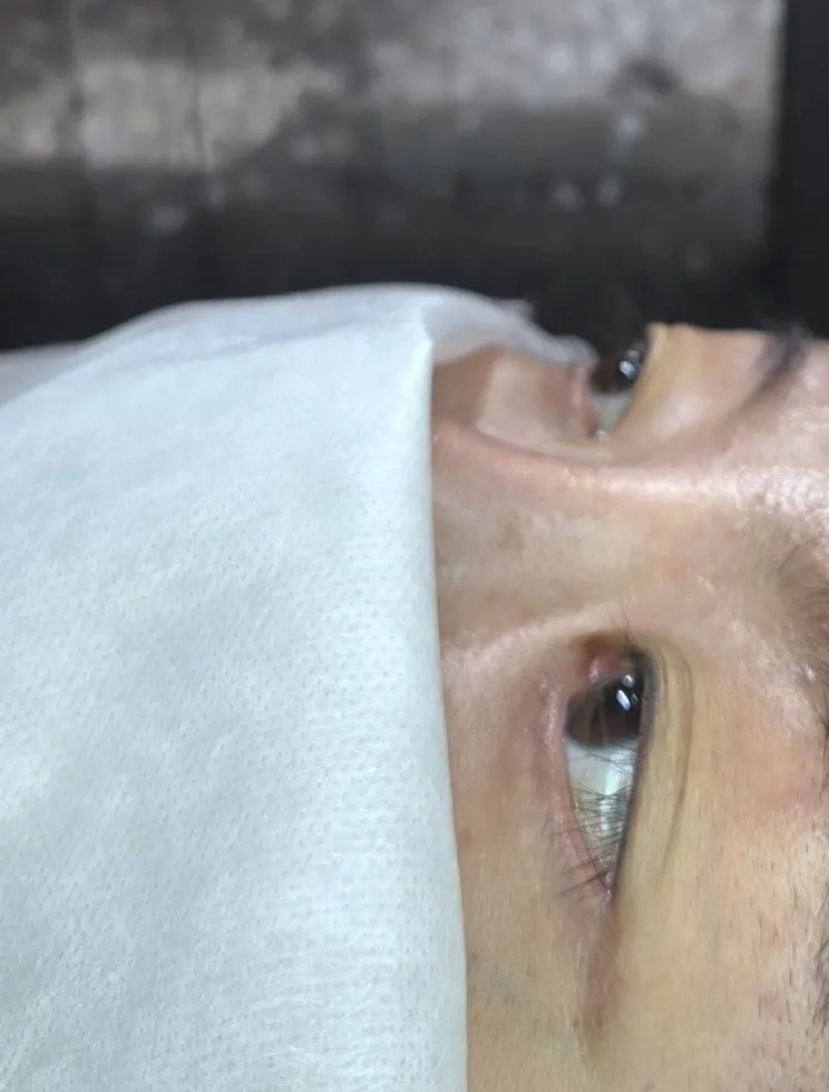 Before photo showing droopy lashes prior to treatment