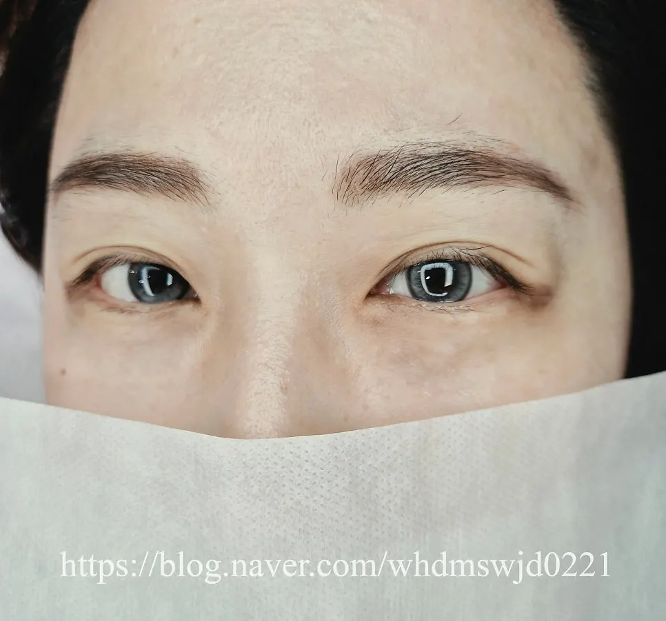 Sparse eyelashes before treatment